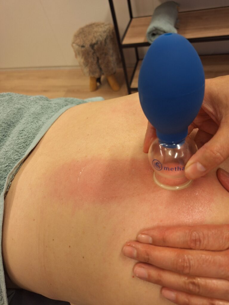 cupping